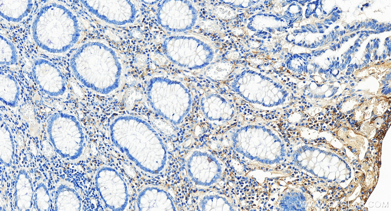 Immunohistochemistry (IHC) staining of human colon cancer tissue using TEM1 Polyclonal antibody (18160-1-AP)