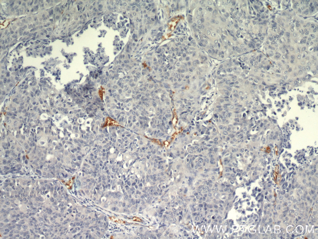 Immunohistochemistry (IHC) staining of human lung cancer tissue using TEM1 Polyclonal antibody (18160-1-AP)