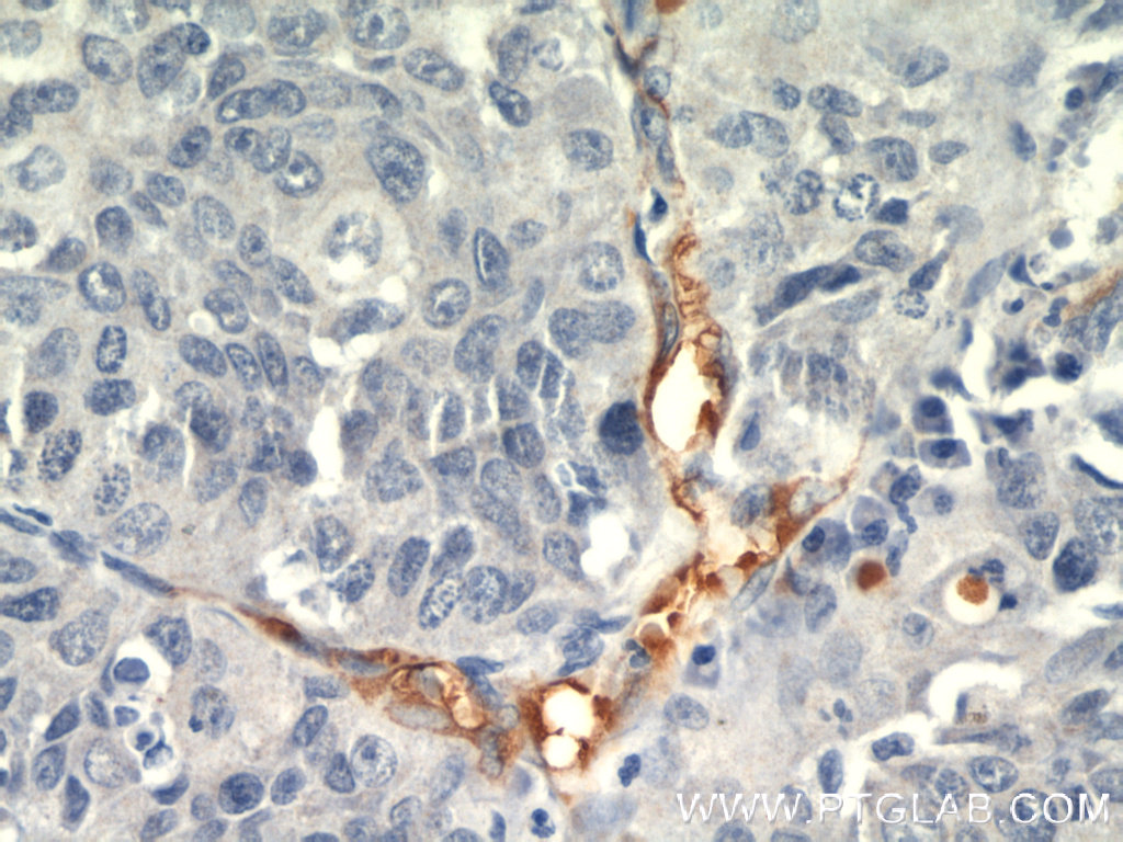 Immunohistochemistry (IHC) staining of human lung cancer tissue using TEM1 Polyclonal antibody (18160-1-AP)