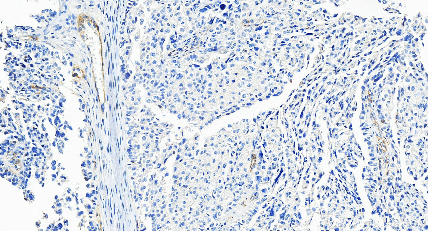 Immunohistochemistry (IHC) staining of human ovary cancer tissue using TEM1 Polyclonal antibody (18160-1-AP)