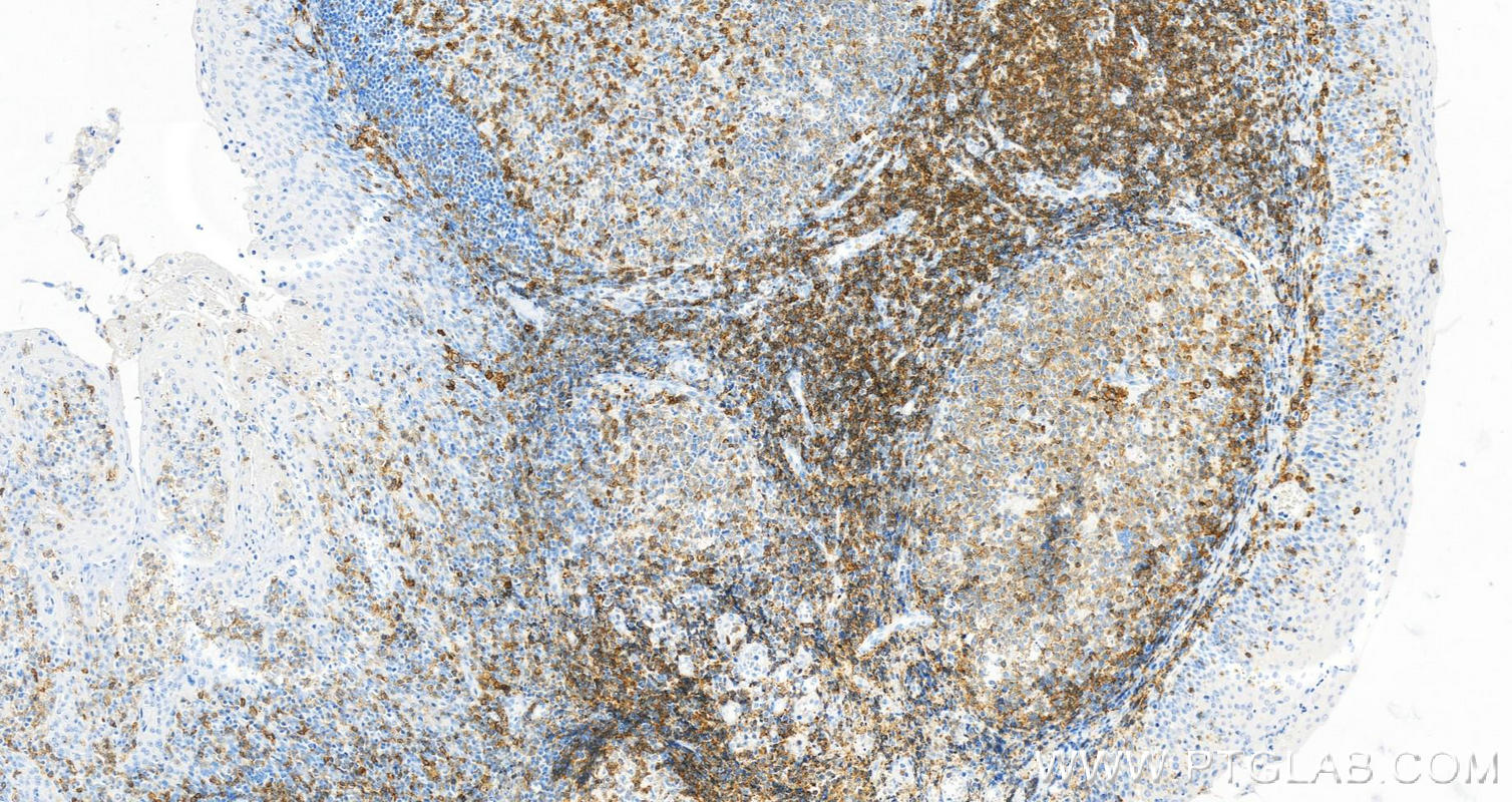 Immunohistochemistry (IHC) staining of human tonsillitis tissue using CD27 Monoclonal antibody (66308-1-Ig)