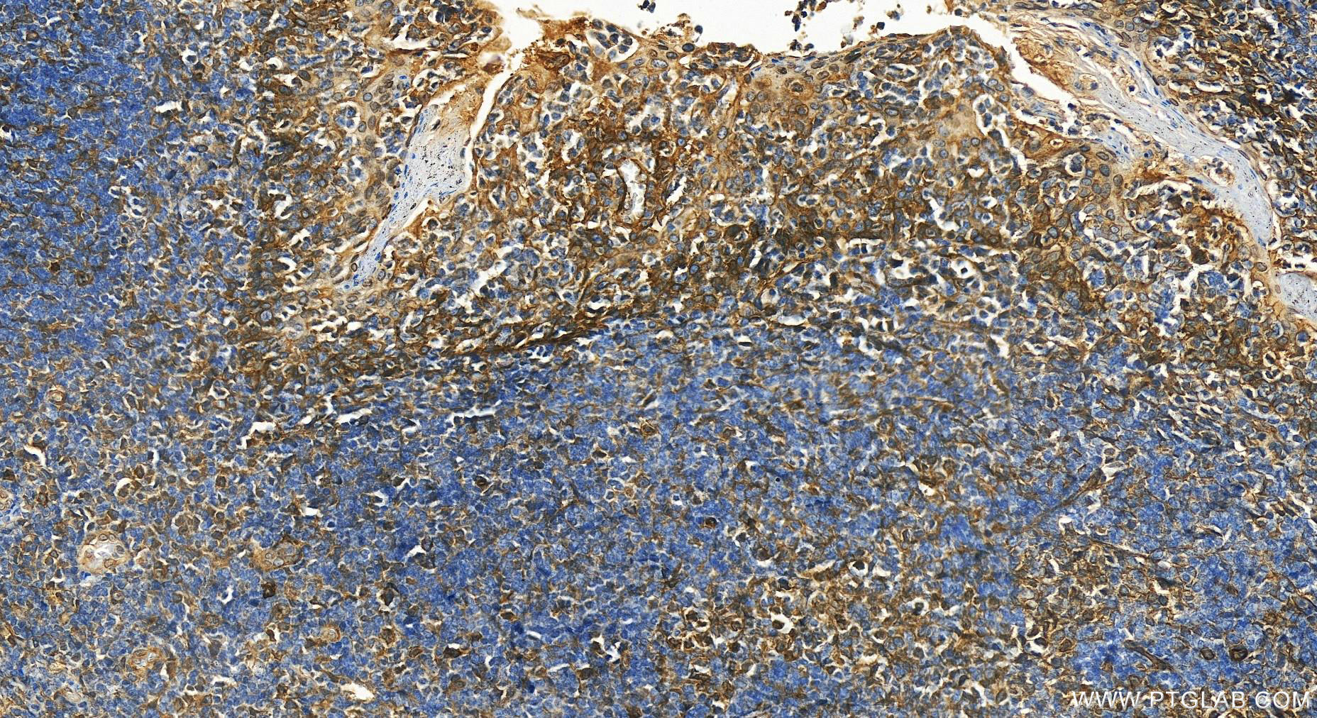 Immunohistochemistry (IHC) staining of human tonsillitis tissue using B7-H3/CD276 Polyclonal antibody (14453-1-AP)