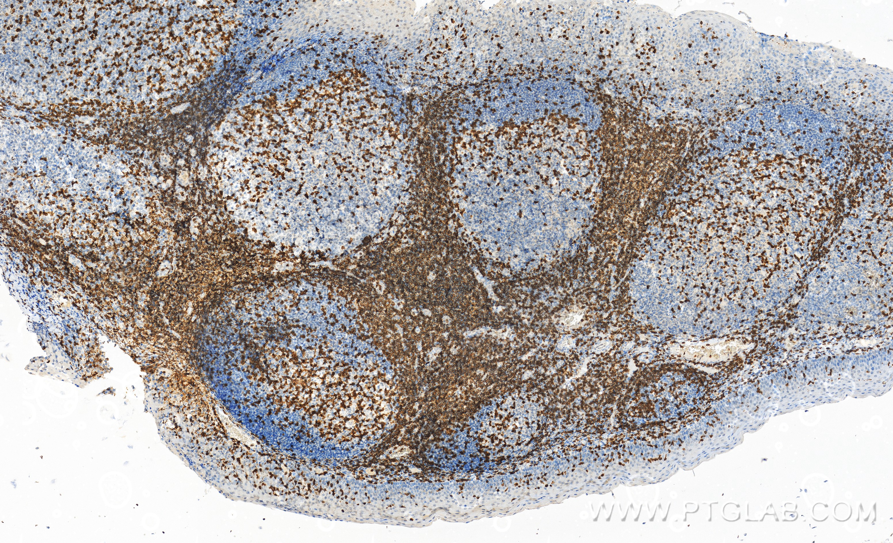 Immunohistochemistry (IHC) staining of human tonsillitis tissue using CD3 Recombinant antibody (81324-1-RR)