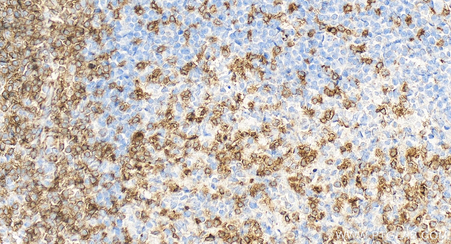 Immunohistochemistry (IHC) staining of human tonsillitis tissue using CD3 Recombinant antibody (84505-4-RR)