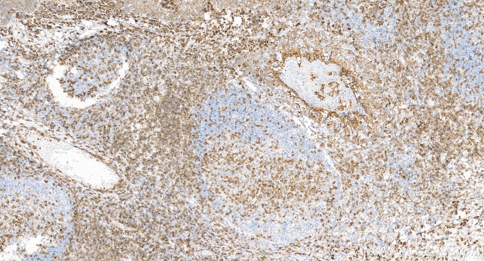 Immunohistochemistry (IHC) staining of human tonsillitis tissue using CD3 Recombinant antibody (84505-4-RR)