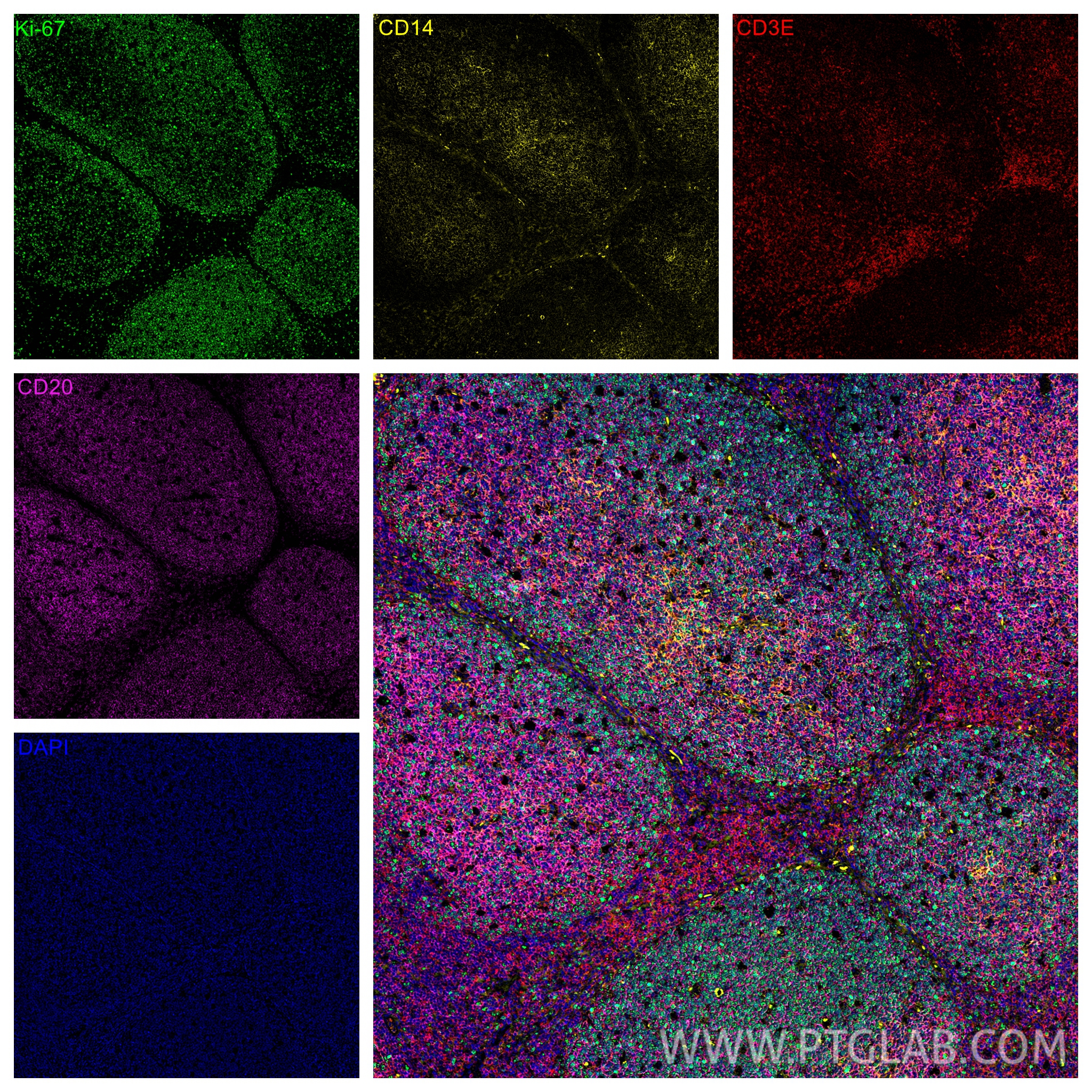 Immunofluorescence (IF) / fluorescent staining of human tonsillitis tissue using CoraLite®594-conjugated CD3 Monoclonal antibody (CL594-60181)