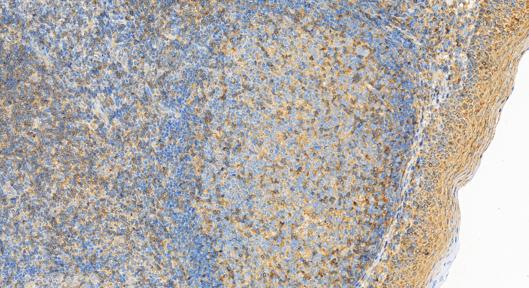 Immunohistochemistry (IHC) staining of human tonsillitis tissue using CD3 Delta Polyclonal antibody (32144-1-AP)