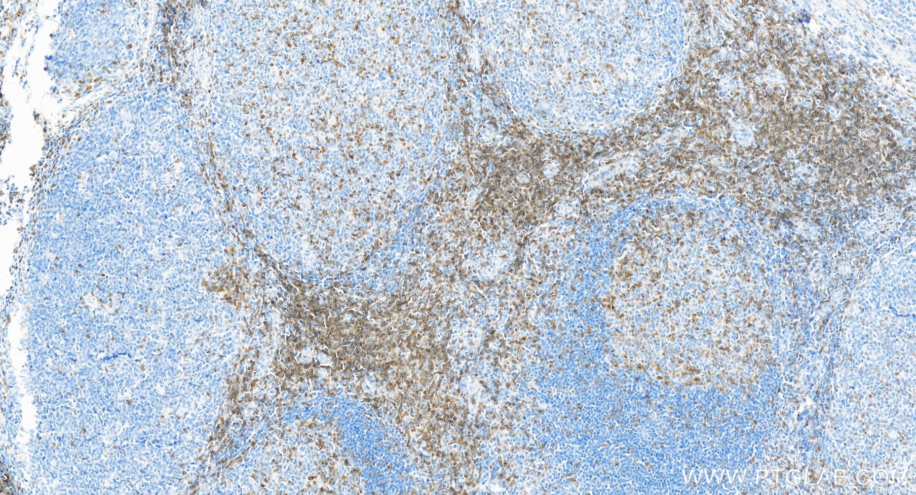 Immunohistochemistry (IHC) staining of human tonsillitis tissue using CD3 Delta Recombinant antibody (84214-4-RR)