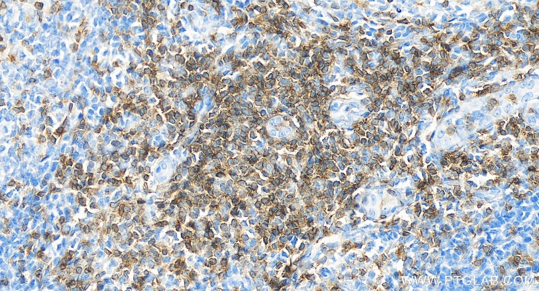 Immunohistochemistry (IHC) staining of human tonsillitis tissue using CD3 Delta Recombinant antibody (84214-4-RR)