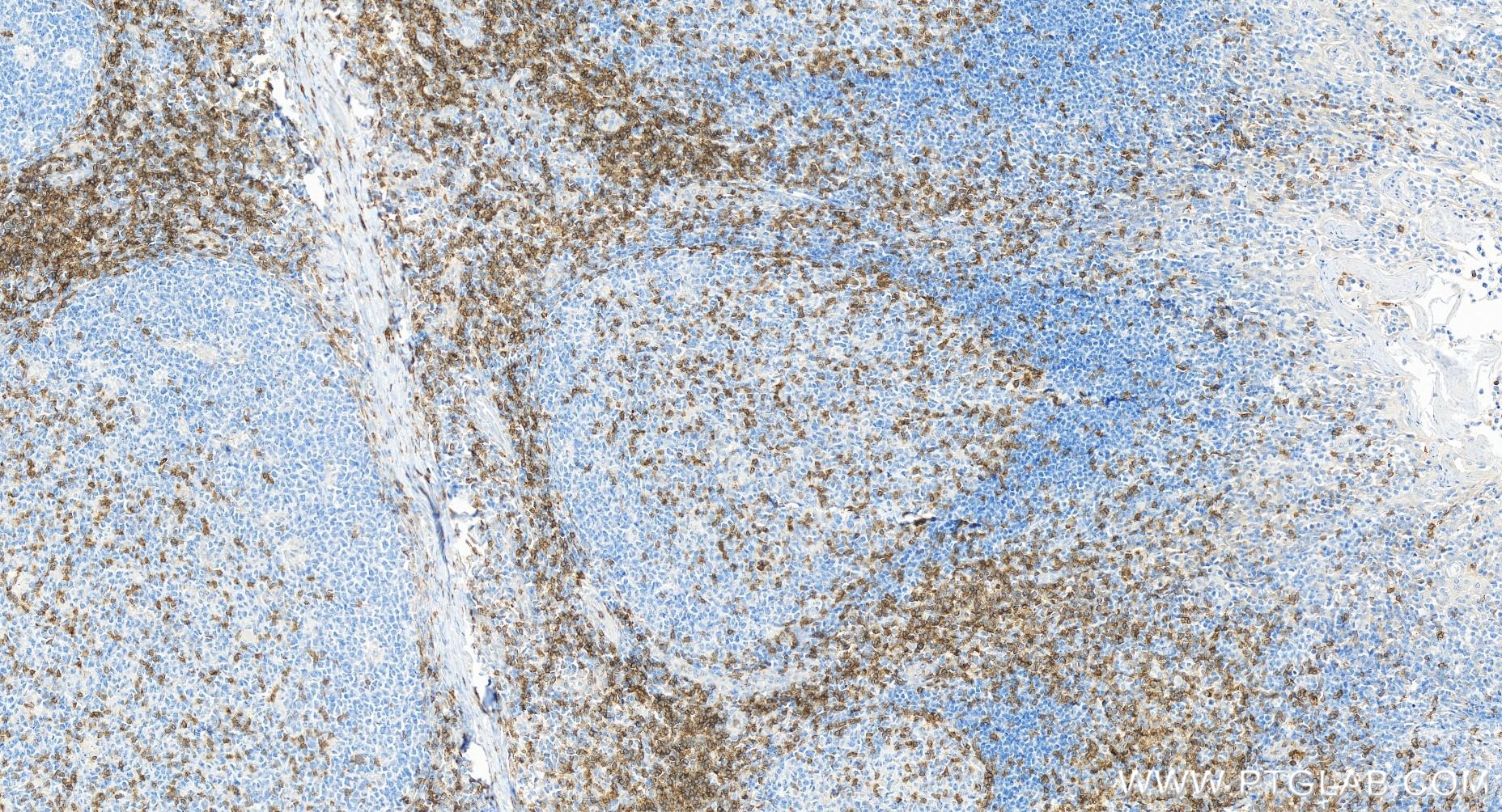 Immunohistochemistry (IHC) staining of human tonsillitis tissue using CD3 Gamma Recombinant antibody (84836-1-RR)