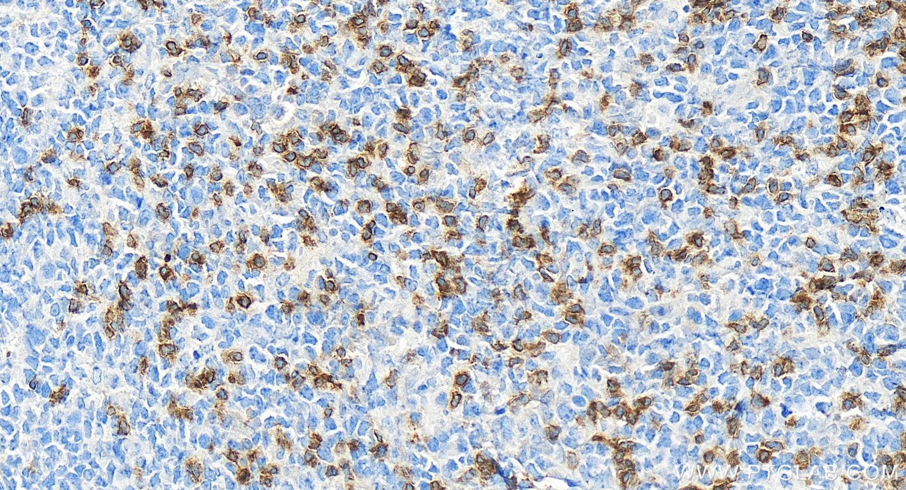 Immunohistochemistry (IHC) staining of human tonsillitis tissue using CD3 Gamma Recombinant antibody (84836-1-RR)