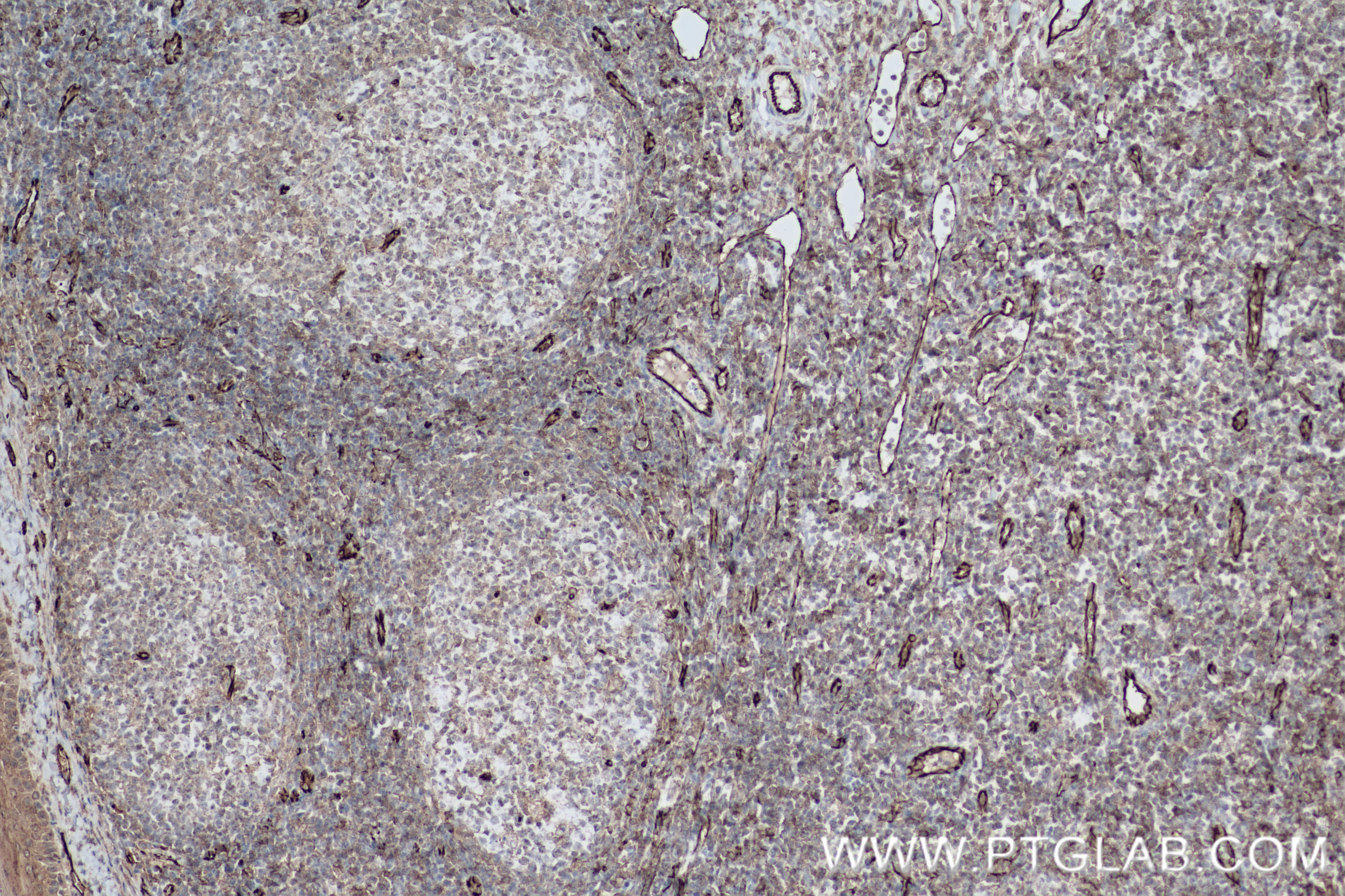 Immunohistochemistry (IHC) staining of human tonsillitis tissue using CD31 Recombinant antibody (80530-1-RR)