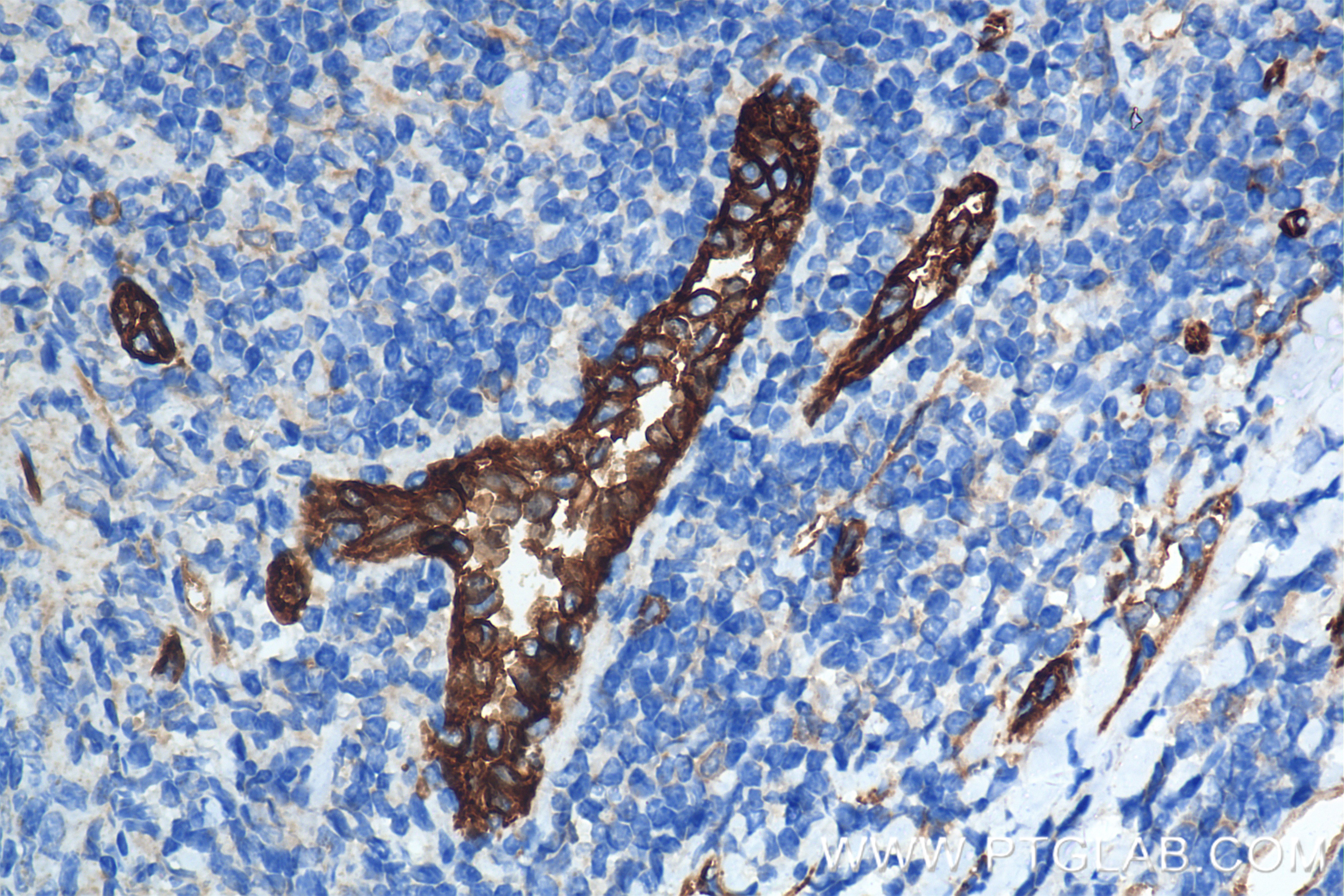 Immunohistochemistry (IHC) staining of human tonsillitis tissue using CD31 Recombinant antibody (80530-1-RR)