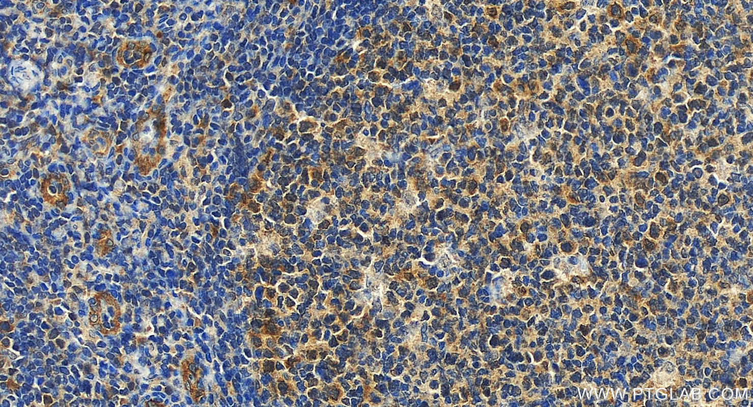 Immunohistochemistry (IHC) staining of human tonsillitis tissue using CD320 Polyclonal antibody (24145-1-AP)