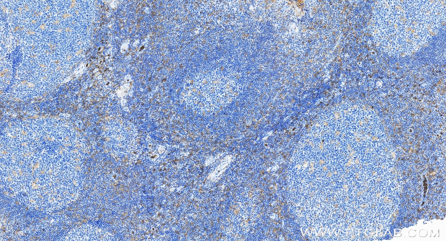 Immunohistochemistry (IHC) staining of human tonsillitis tissue using CD33 Recombinant antibody (84341-3-RR)