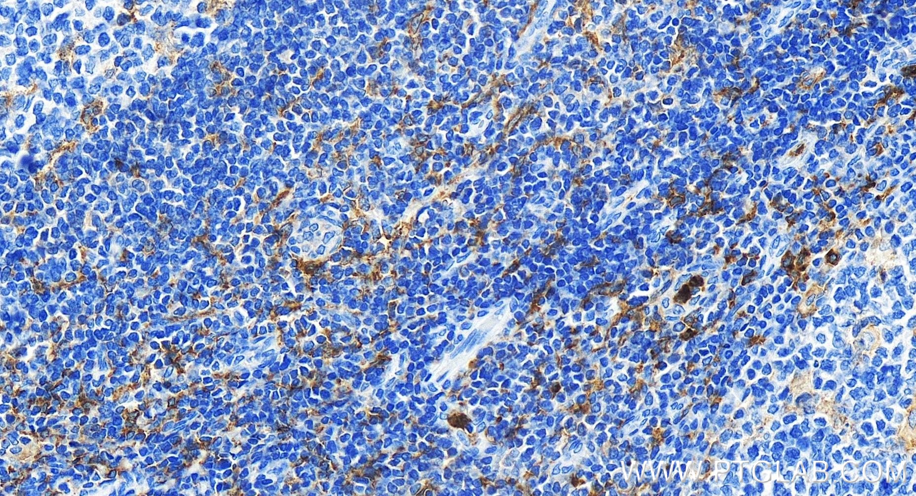 Immunohistochemistry (IHC) staining of human tonsillitis tissue using CD33 Recombinant antibody (84341-3-RR)