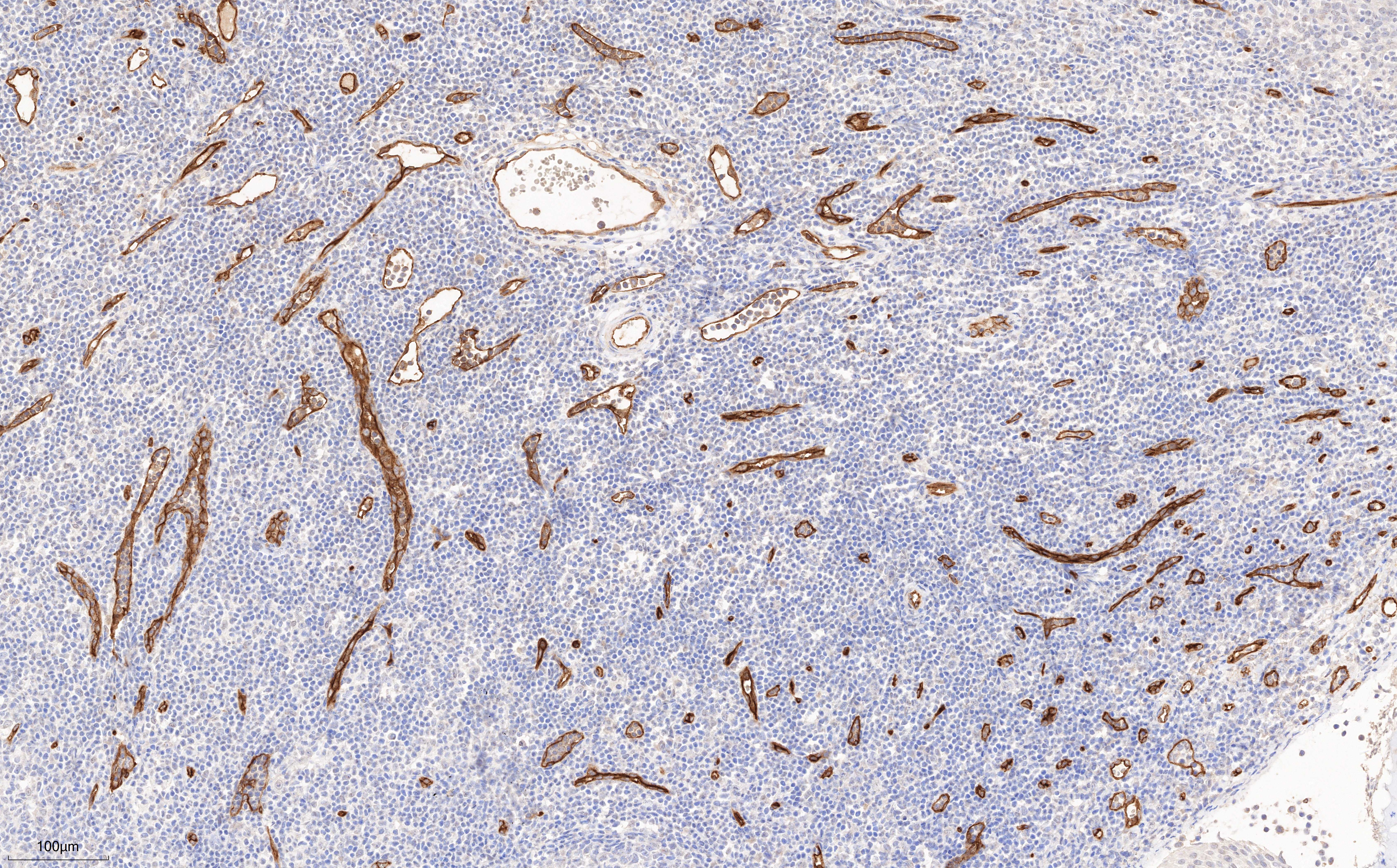 Immunohistochemistry (IHC) staining of human tonsillitis tissue using CD34 Monoclonal antibody (60180-2-Ig)