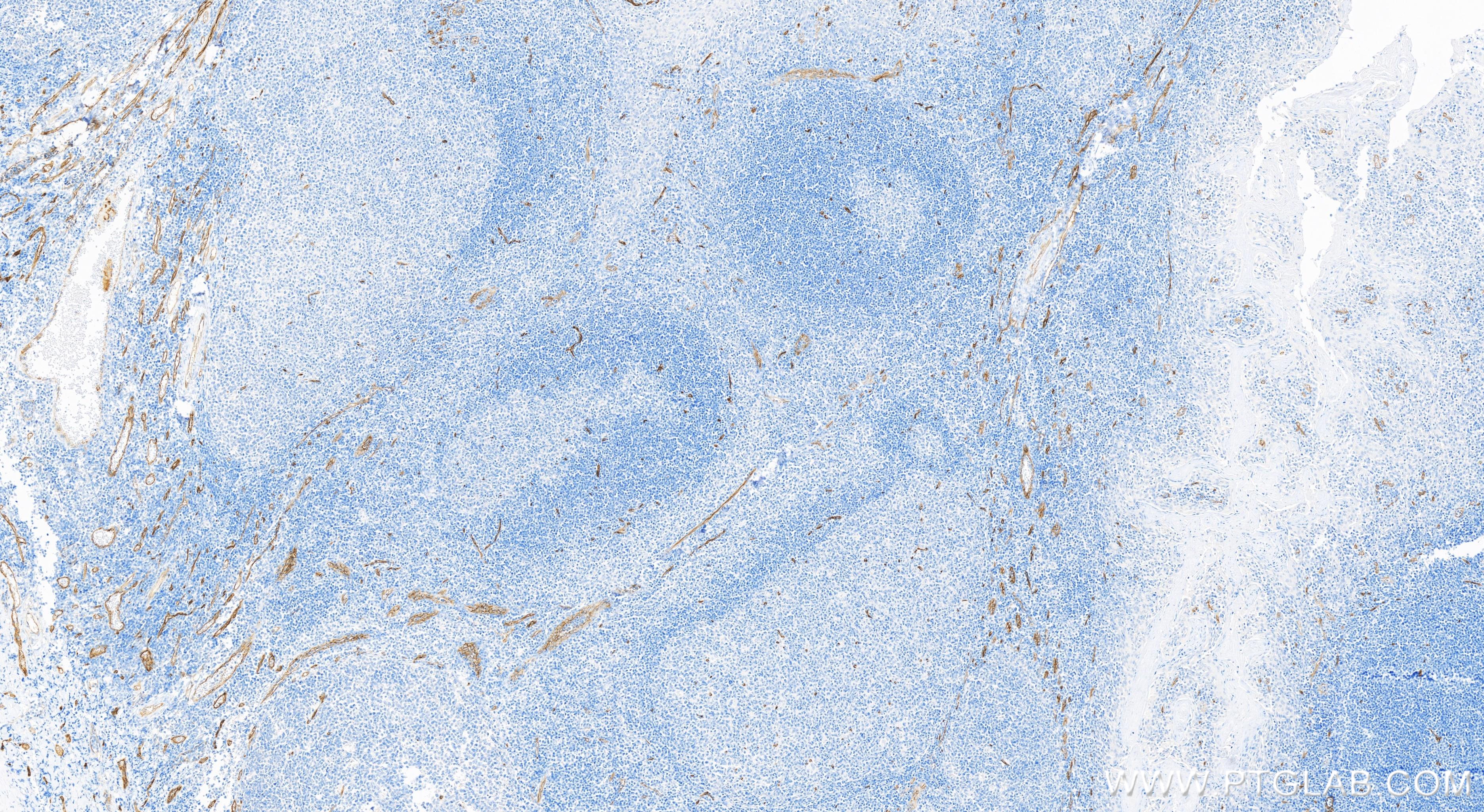 Immunohistochemistry (IHC) staining of human tonsillitis tissue using CD34 Recombinant antibody (84242-5-RR)