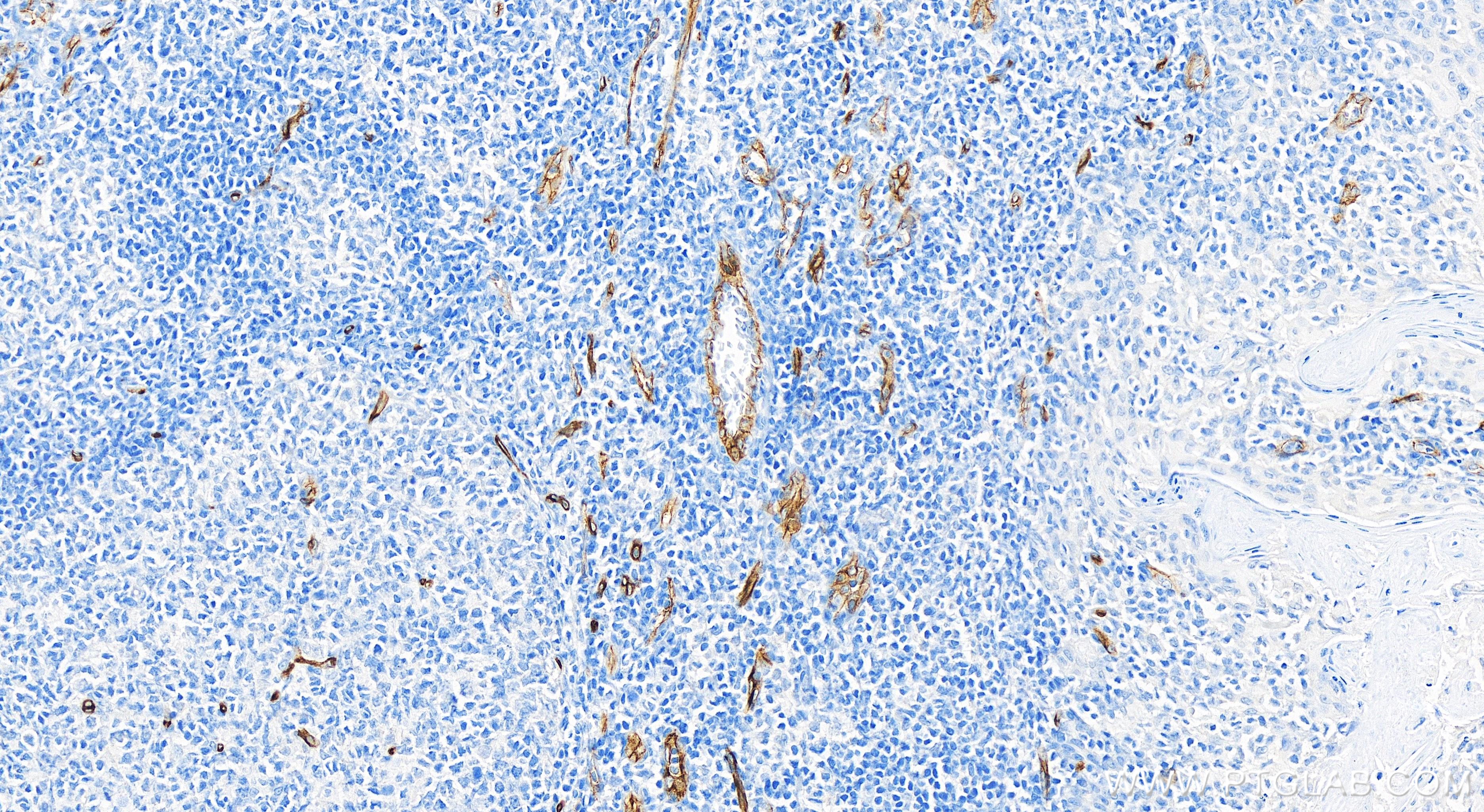 Immunohistochemistry (IHC) staining of human tonsillitis tissue using CD34 Recombinant antibody (84242-5-RR)