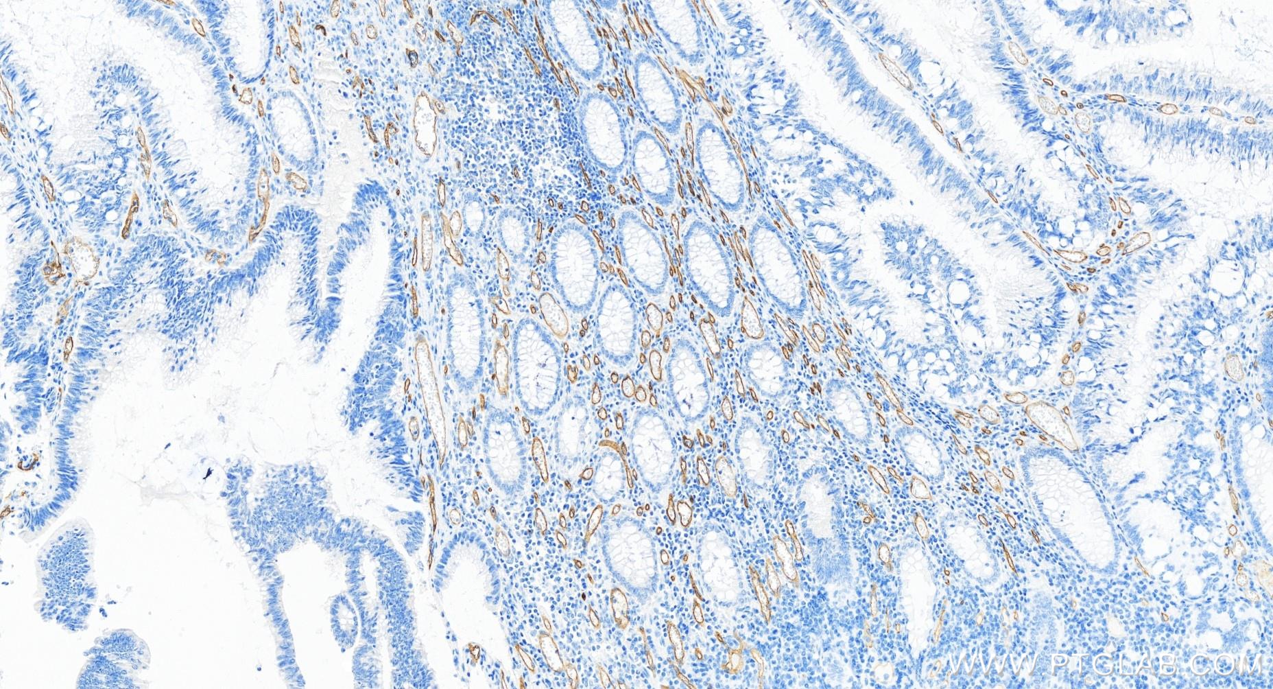 Immunohistochemistry (IHC) staining of human colon cancer tissue using CD34 Recombinant antibody (84242-5-RR)