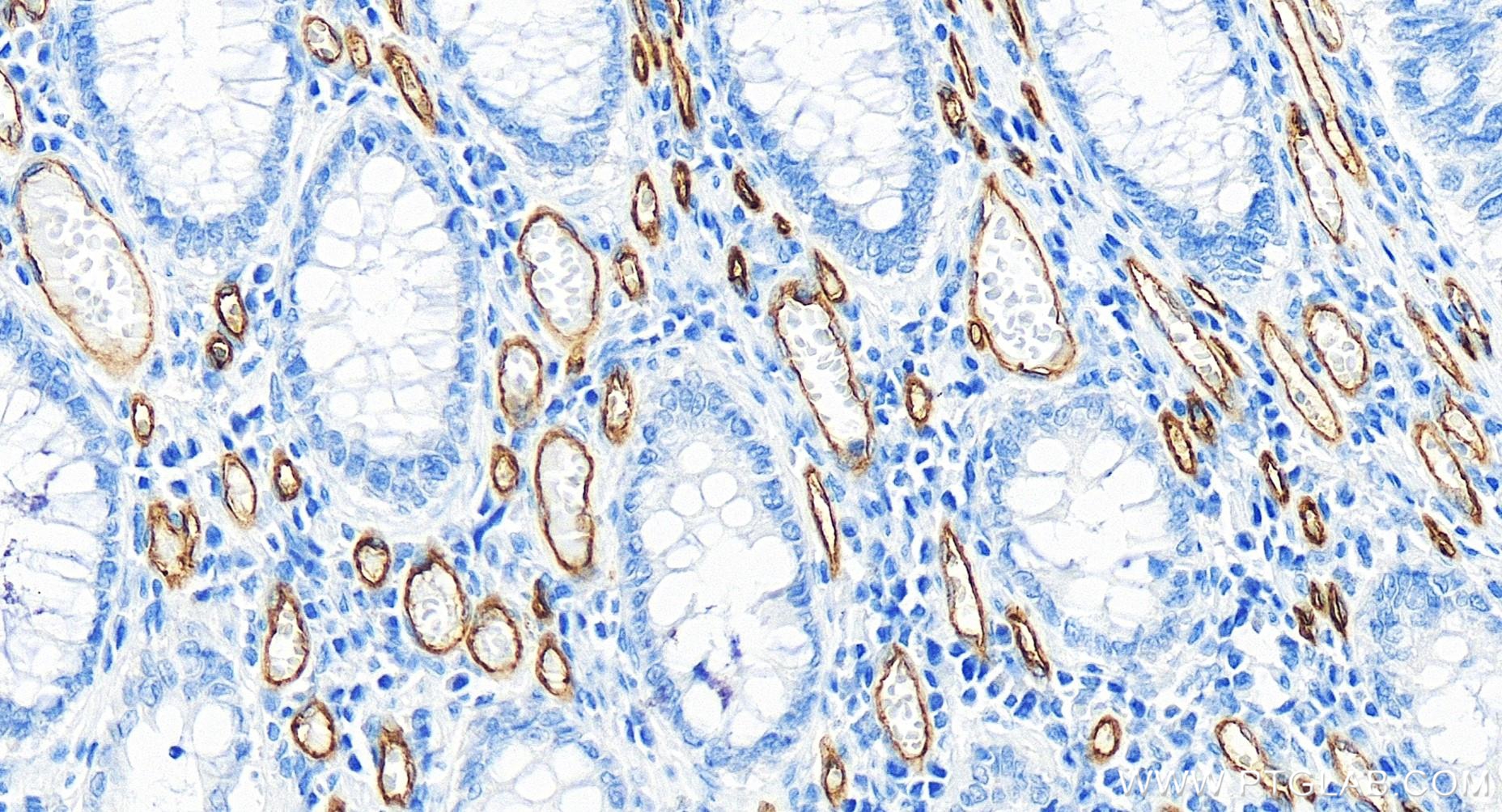 Immunohistochemistry (IHC) staining of human colon cancer tissue using CD34 Recombinant antibody (84242-5-RR)