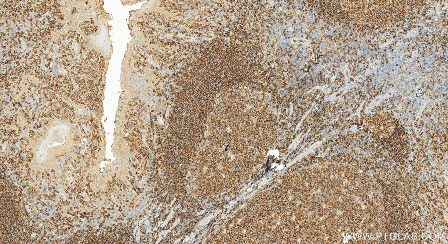 Immunohistochemistry (IHC) staining of human tonsillitis tissue using CD37 Polyclonal antibody (21044-1-AP)
