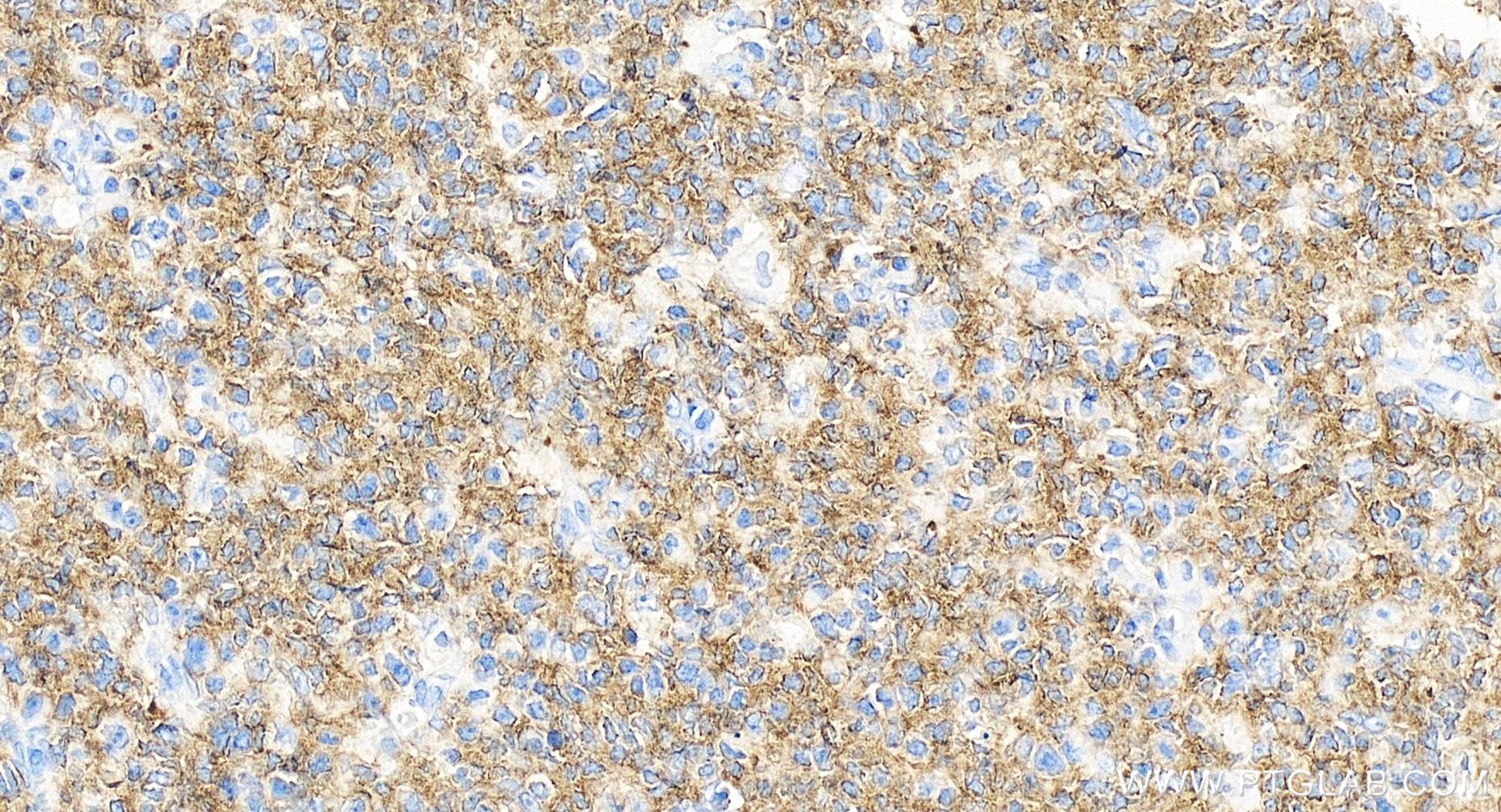 Immunohistochemistry (IHC) staining of human tonsillitis tissue using CD37 Recombinant antibody (84509-2-RR)