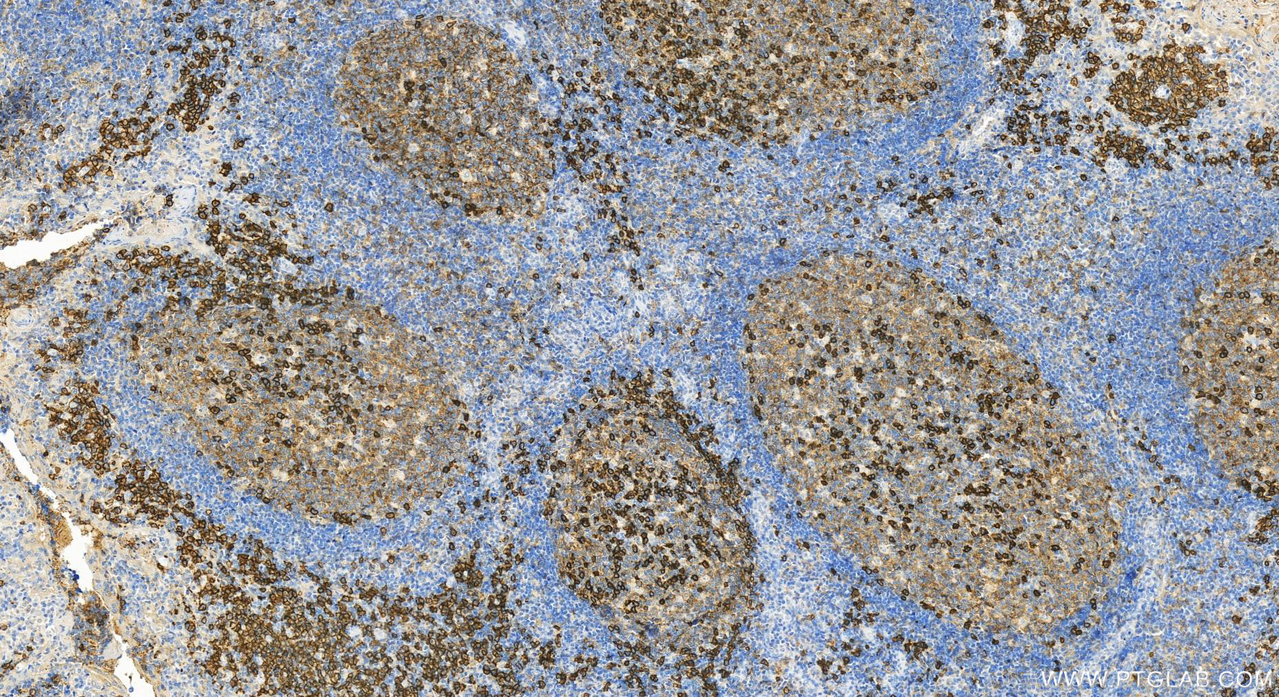 Immunohistochemistry (IHC) staining of human tonsillitis tissue using CD38 Polyclonal antibody (31891-1-AP)