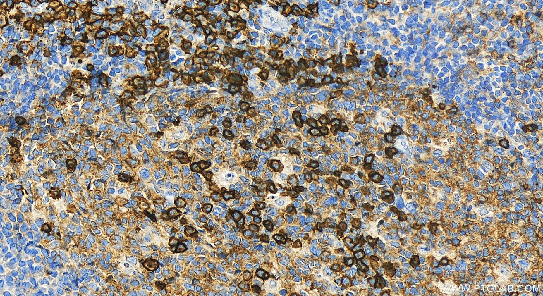 Immunohistochemistry (IHC) staining of human tonsillitis tissue using CD38 Polyclonal antibody (31891-1-AP)