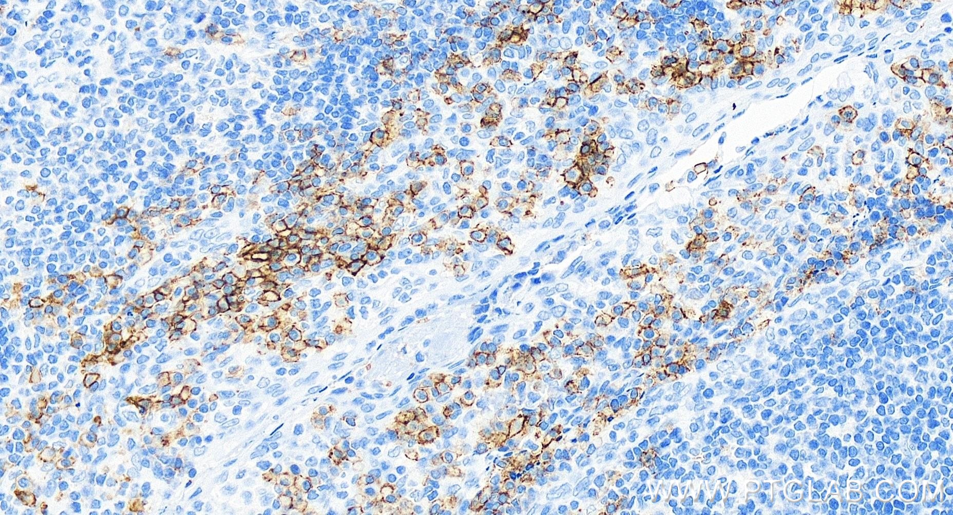 Immunohistochemistry (IHC) staining of human tonsillitis tissue using CD38 Recombinant antibody (84070-2-RR)