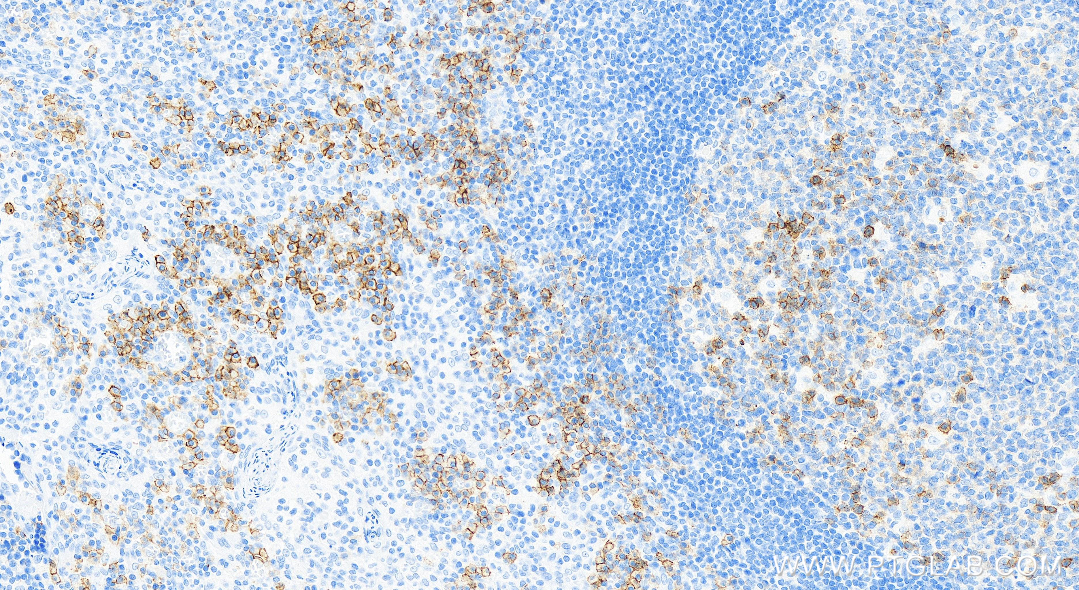 Immunohistochemistry (IHC) staining of human tonsillitis tissue using CD38 Recombinant antibody (84070-2-RR)