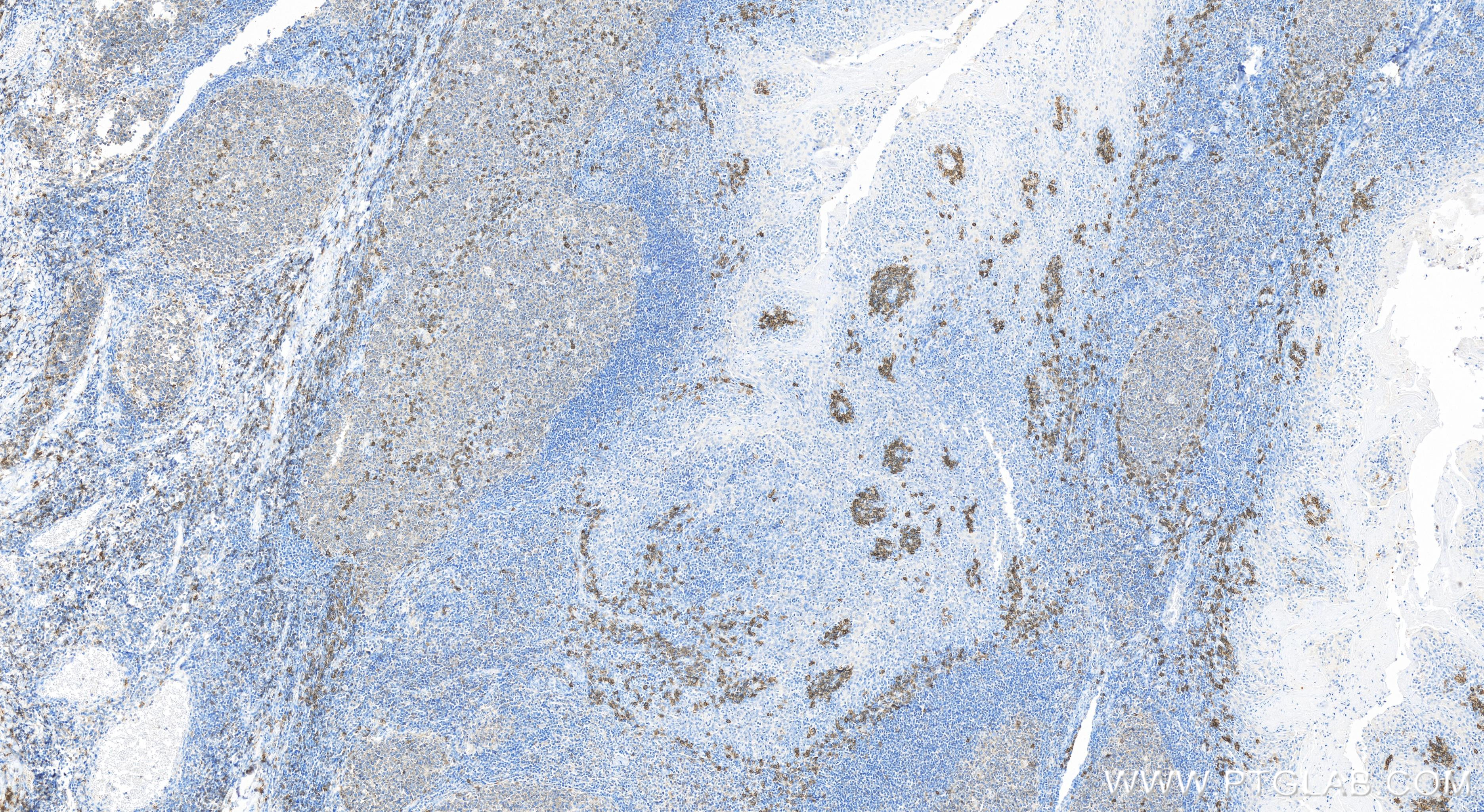 Immunohistochemistry (IHC) staining of human tonsillitis tissue using CD38 Recombinant antibody (84070-3-RR)