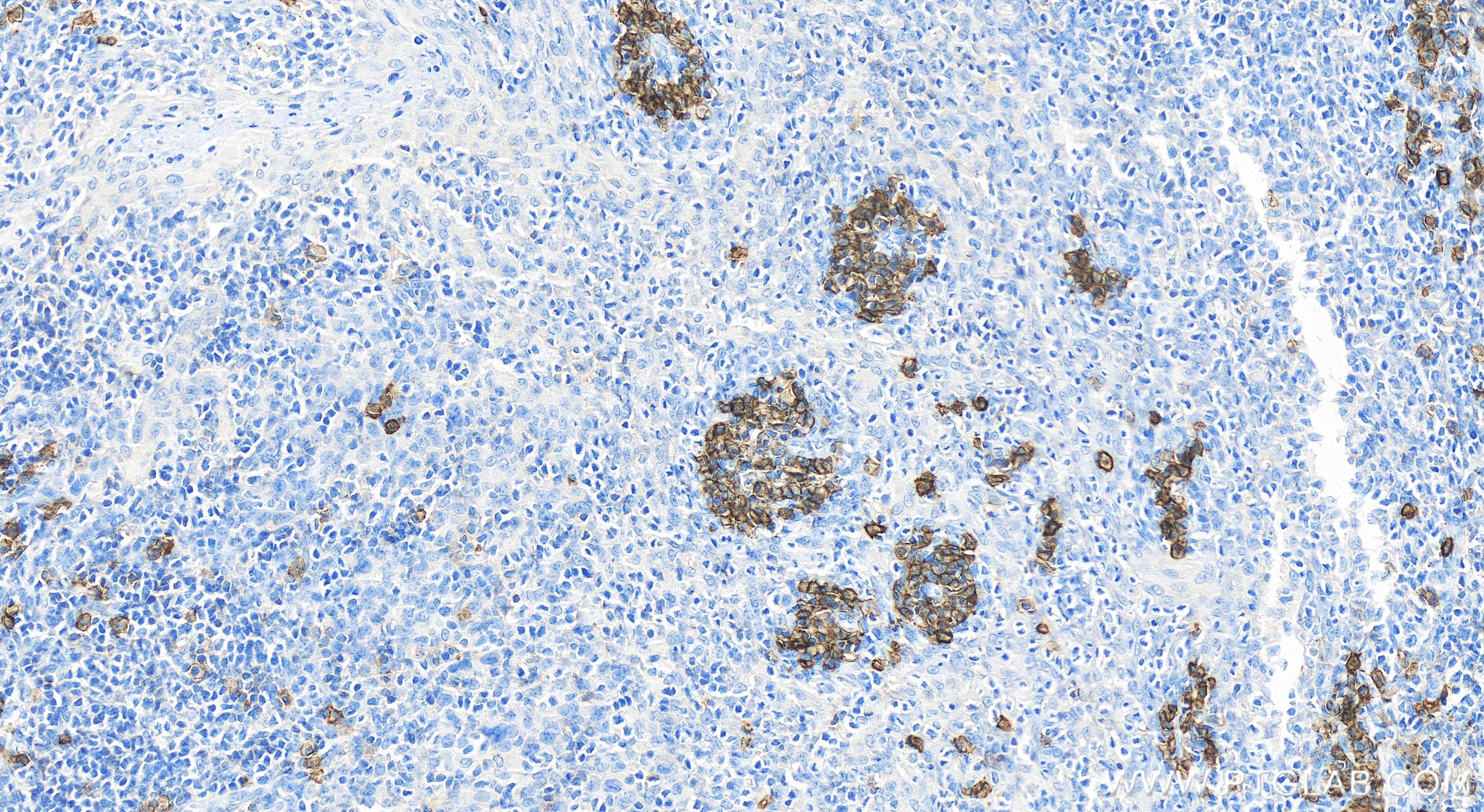 Immunohistochemistry (IHC) staining of human tonsillitis tissue using CD38 Recombinant antibody (84070-3-RR)