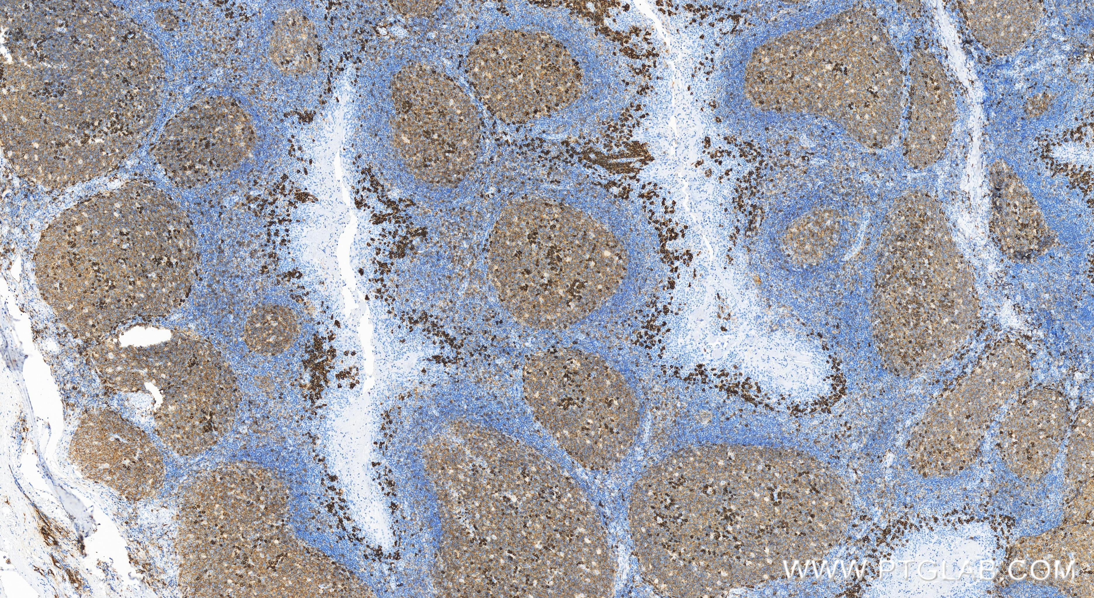 Immunohistochemistry (IHC) staining of human tonsillitis tissue using CD38 Recombinant antibody (84070-6-RR)