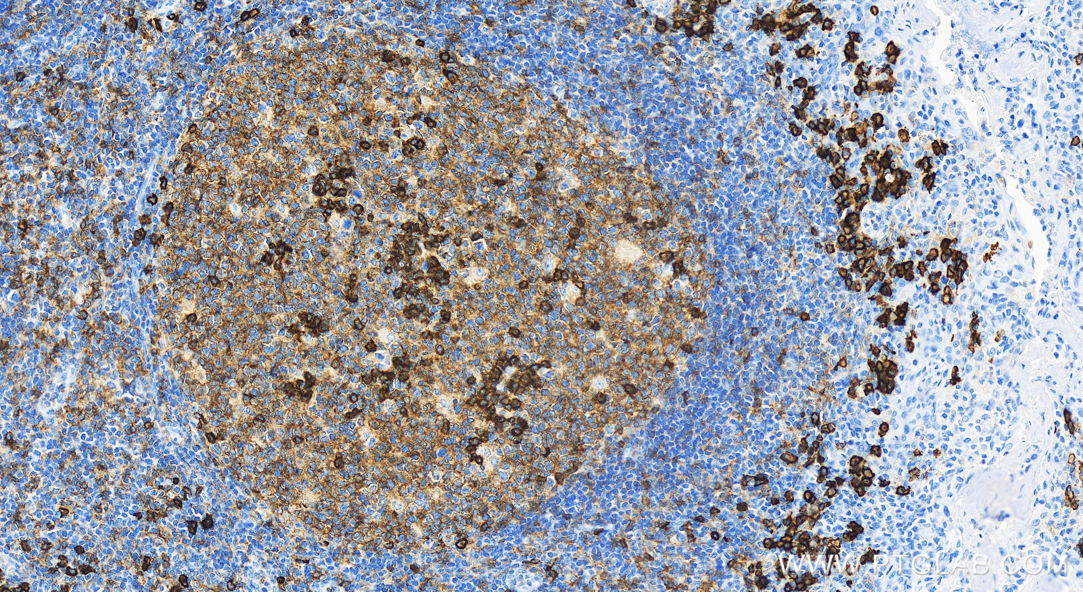 Immunohistochemistry (IHC) staining of human tonsillitis tissue using CD38 Recombinant antibody (84070-6-RR)