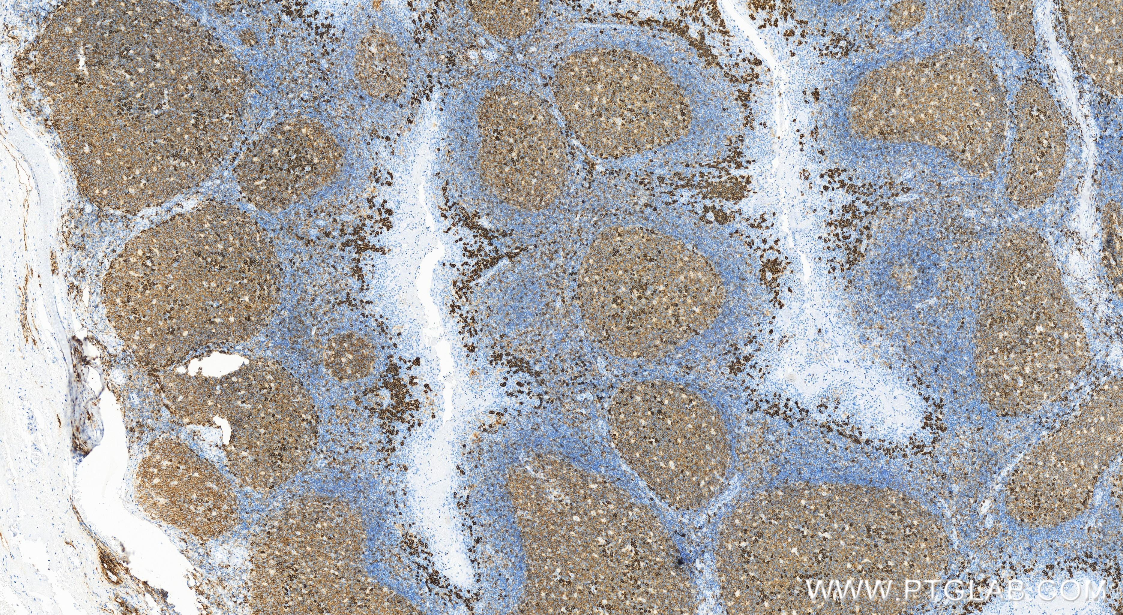 Immunohistochemistry (IHC) staining of human tonsillitis tissue using CD38 Recombinant antibody (84070-6-RR)