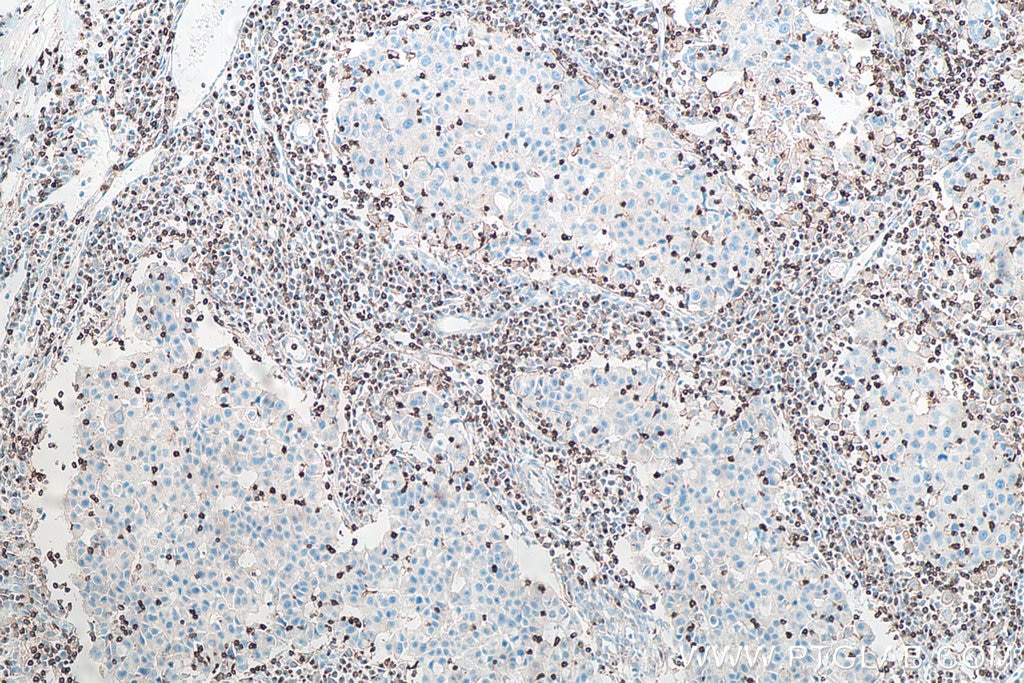 Immunohistochemistry (IHC) staining of human breast cancer tissue using CD3 Monoclonal antibody (60181-1-Ig)