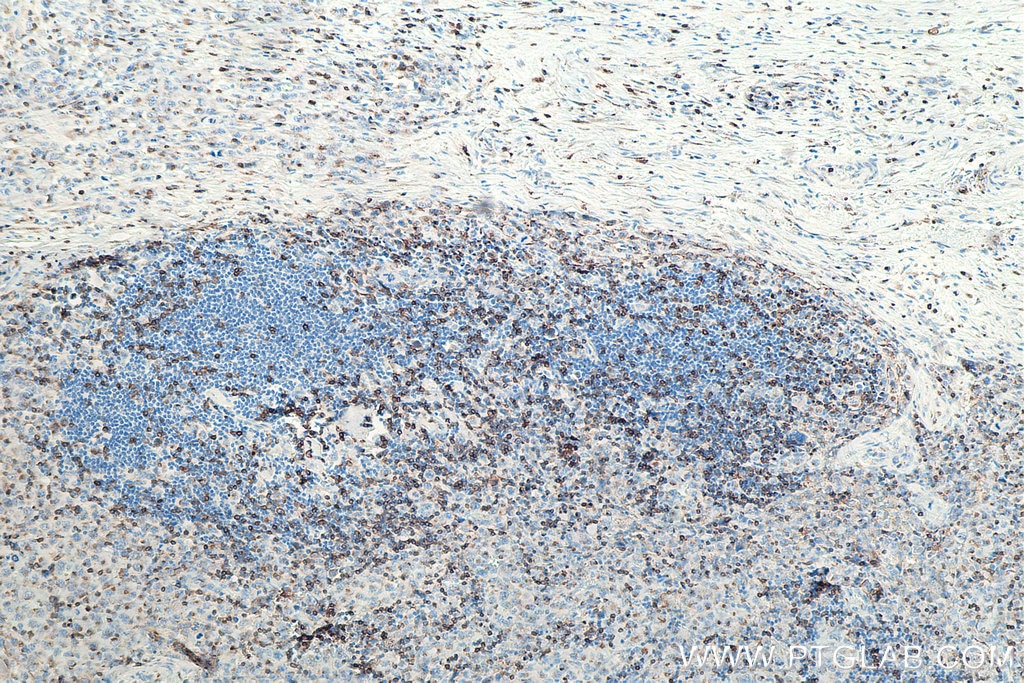 Immunohistochemistry (IHC) staining of human lymphoma tissue using CD3 Monoclonal antibody (60181-1-Ig)