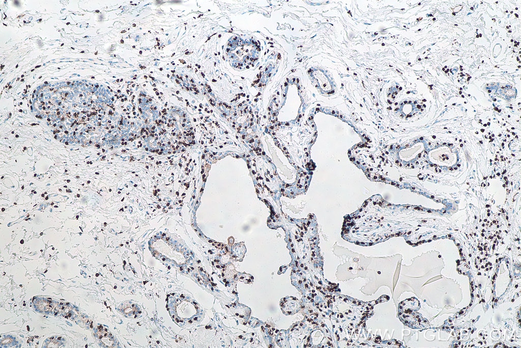 Immunohistochemistry (IHC) staining of human breast cancer tissue using CD3 Monoclonal antibody (60181-1-Ig)
