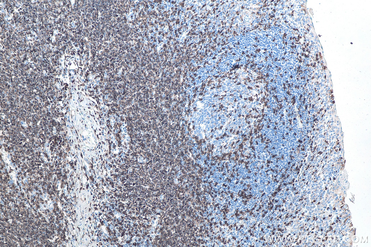 Immunohistochemistry (IHC) staining of human tonsillitis tissue using CD3 Monoclonal antibody (60181-1-Ig)