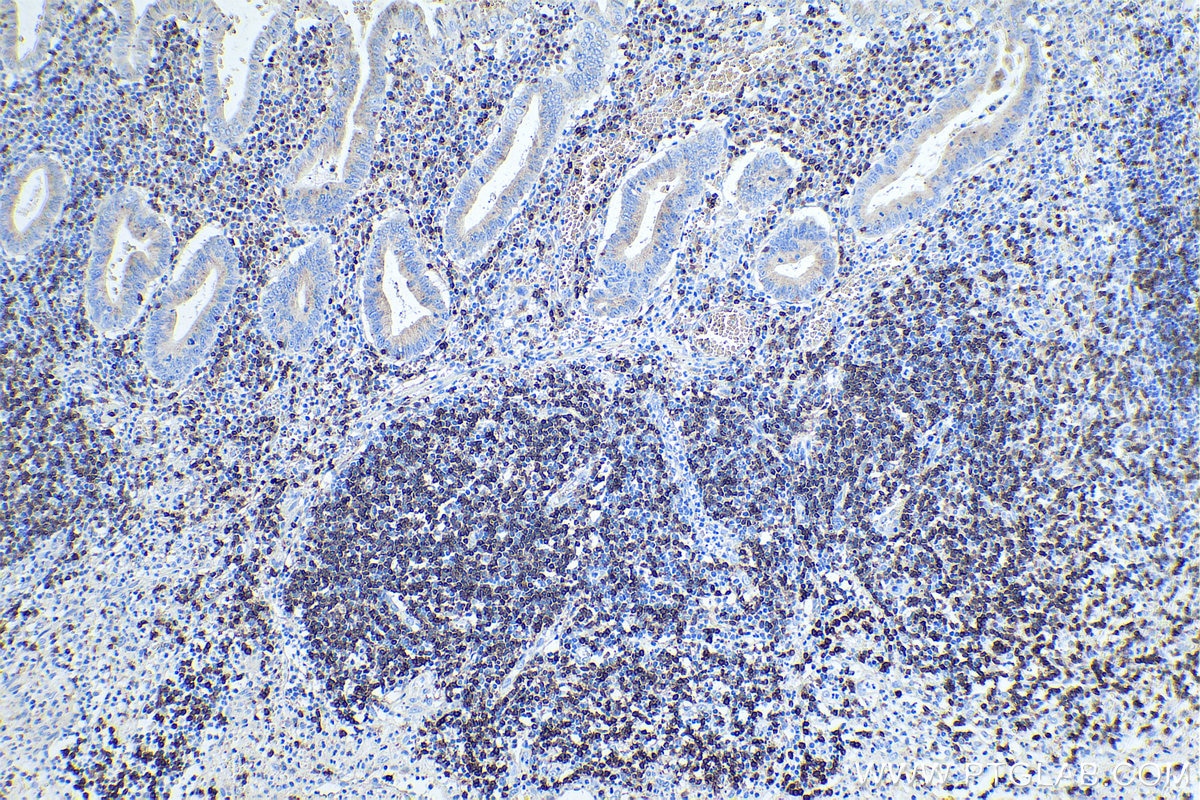 Immunohistochemistry (IHC) staining of human appendicitis tissue using CD3 Monoclonal antibody (60181-1-Ig)