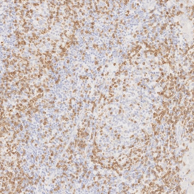 Immunohistochemistry (IHC) staining of human lymphoma tissue using CD3 Monoclonal antibody (60181-1-Ig)