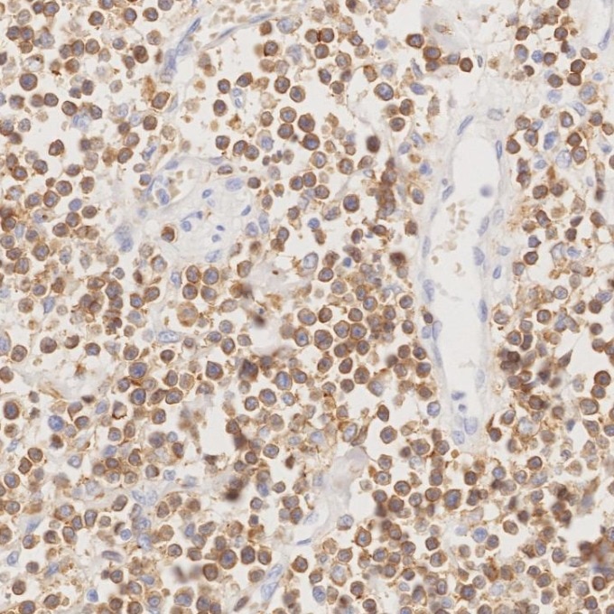 Immunohistochemistry (IHC) staining of human lymphoma tissue using CD3 Monoclonal antibody (60181-1-Ig)