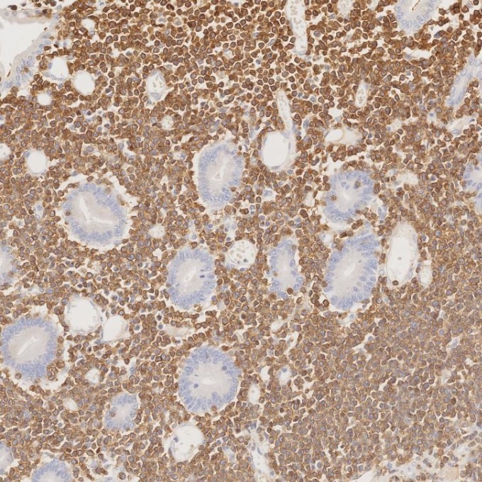 Immunohistochemistry (IHC) staining of human lymphoma tissue using CD3 Monoclonal antibody (60181-1-Ig)