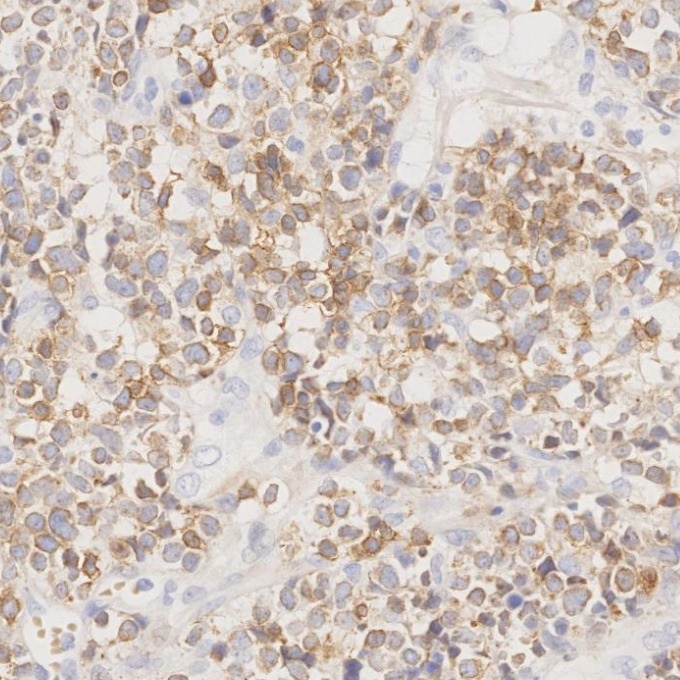 Immunohistochemistry (IHC) staining of human lymphoma tissue using CD3 Monoclonal antibody (60181-1-Ig)