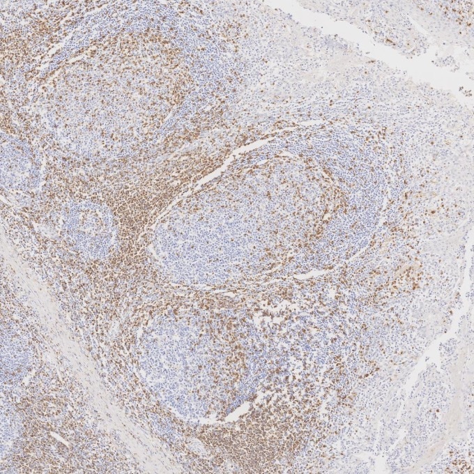 Immunohistochemistry (IHC) staining of human tonsillitis tissue using CD3 Monoclonal antibody (60181-1-Ig)