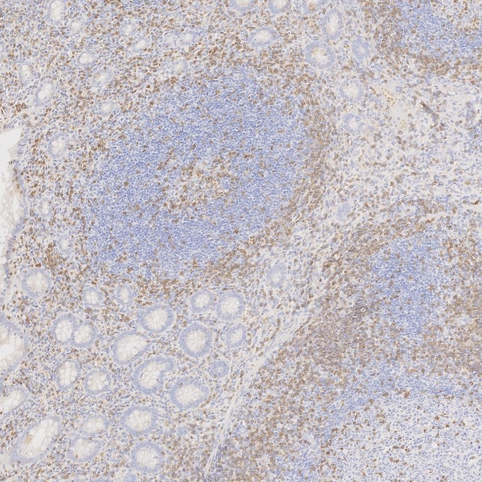 Immunohistochemistry (IHC) staining of human appendicitis tissue using CD3 Monoclonal antibody (60181-1-Ig)