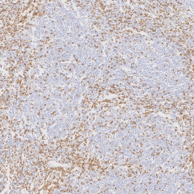 Immunohistochemistry (IHC) staining of human lymphoma tissue using CD3 Monoclonal antibody (60181-1-Ig)