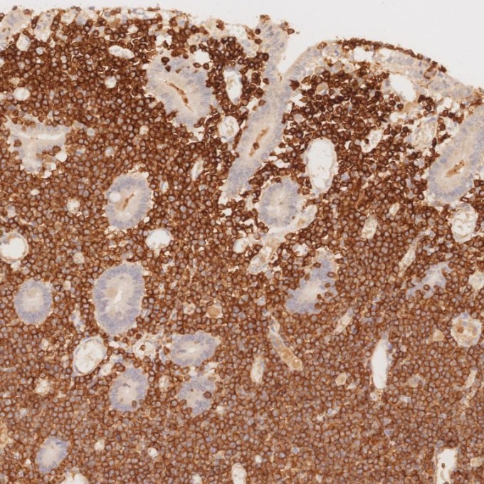 Immunohistochemistry (IHC) staining of human lymphoma tissue using CD3 Monoclonal antibody (60181-1-Ig)