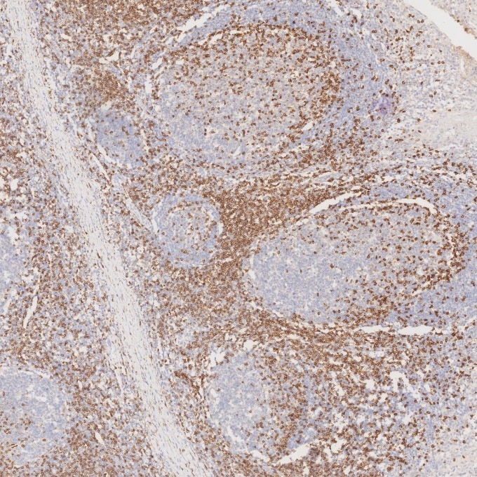 Immunohistochemistry (IHC) staining of human tonsillitis tissue using CD3 Monoclonal antibody (60181-1-Ig)